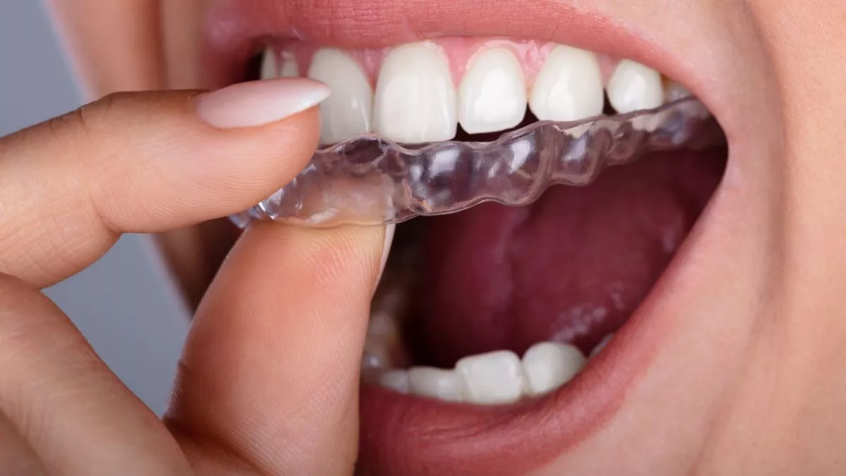 ¿Cómo eran los primeros brackets y cómo serán los del futuro?